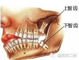 智齿究竟要不要拔?完全取决于·····
