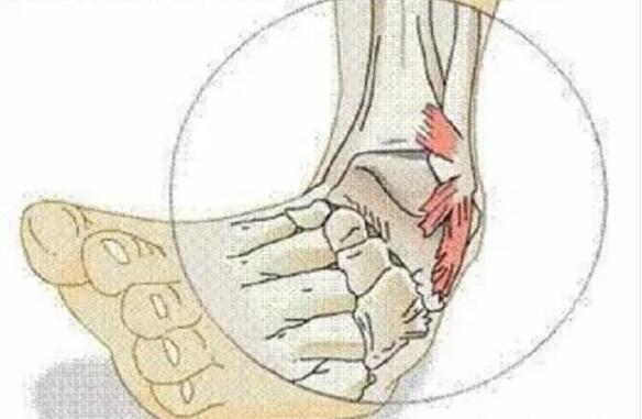 崴脚了怎么办 能不能揉?冷敷还是热敷?