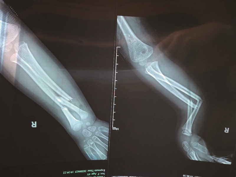 4岁女孩 阿外楼 游乐设施上摔下致右手严重骨折 新闻中心 温州网