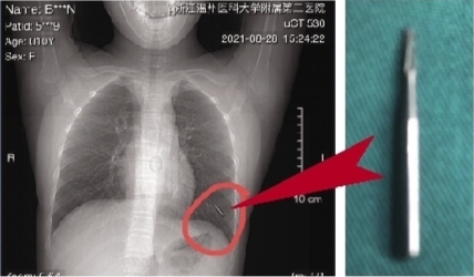 器械脱落滑进11岁女孩气管 医生妙手寻针避免切除部分肺