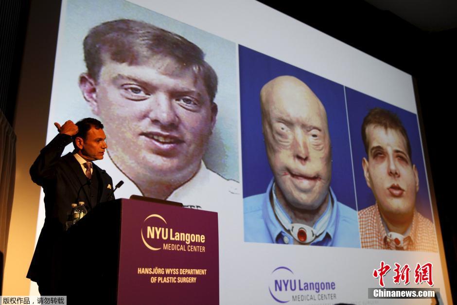 纽约大学完成世界最高难度换脸手术