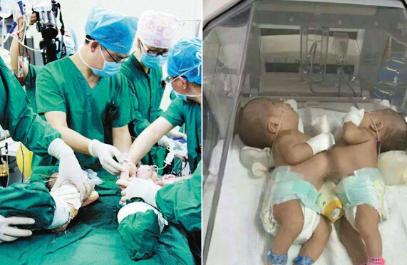 18岁孕妇诞下连体婴儿 手术成功“分离”