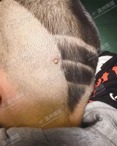 小区草地上玩耍回来 3岁男孩头皮上埋了只蜱虫