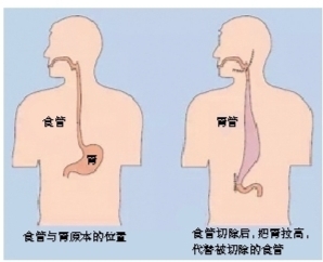 咽喉全切除手术,清扫了颈部淋巴结,并把原本位于腹部的胃塑造成管状