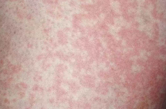 ��������NO.605ح�������ӻ�ϴ������ȷ���Ⱦ��ҽ��: ��������Ҫ�ر�ע��