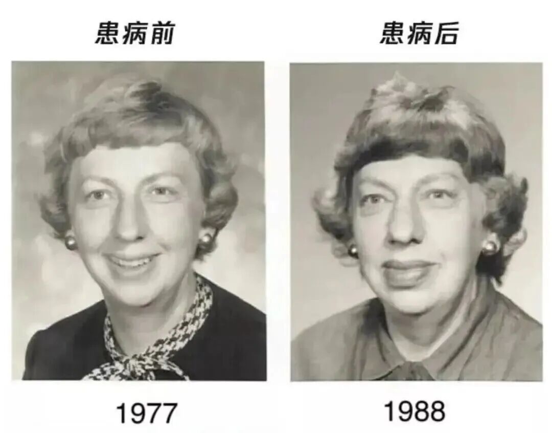 鼻子变大、手脚变粗？别当“发福”，医生：这可能是肿瘤前兆！