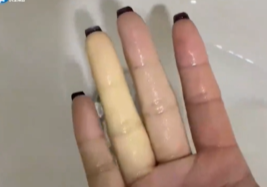 健康真相NO.615丨女子手冻得像“白色香肠”!医生:是“雷诺现象”,严重或致指端坏死或截肢风险