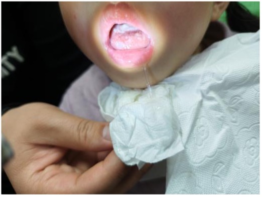 ����˫��̥�������������� ��ҽ�󸽶�Ժ�ϸ��½���20�������ҩ�ﻼ��