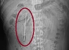 ˮ�����¼ơ�Ǳ��������20�� ��ʱ�������������״��Ѫ