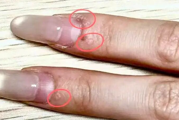 ��������NO.671حһŮ�����׺�ָ����Χ����С���� С��HPV�����������
